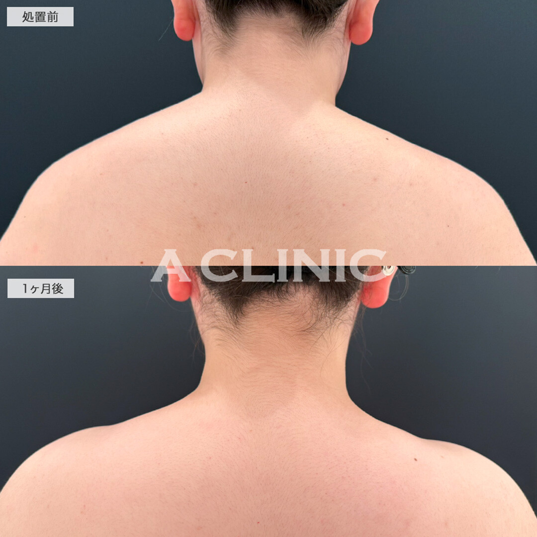 ボトックス注射(肩)で力みのない首肩ラインがスッキリして写真映えUP！こちら処置前と1ヶ月後の症例です(20代女性)