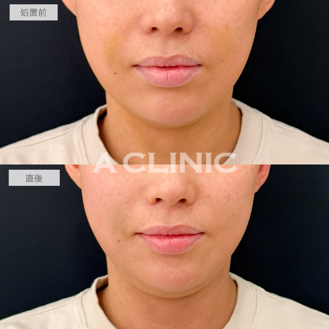 KOライトでダウンタイムを短くできました！処置前と直後の症例です(30代女性)