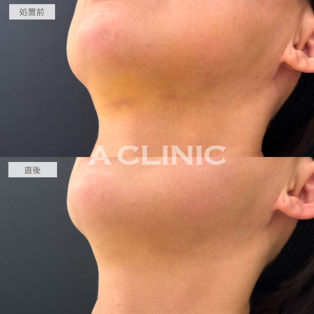 KOライトでダウンタイムを短くできました！処置前と直後の症例です(30代女性)