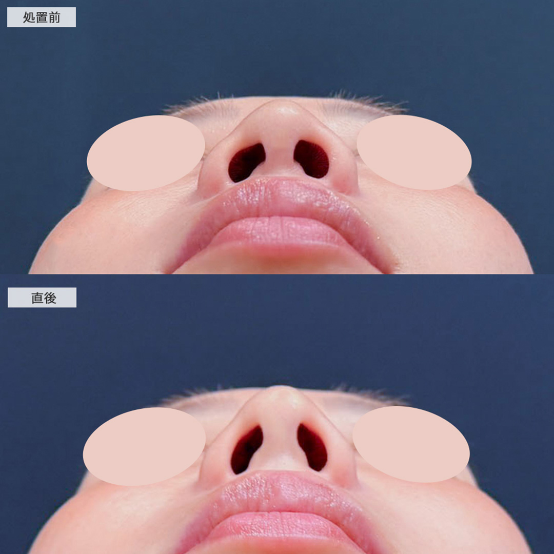 コリアンノーズで直後から韓国アイドルのようなアップノーズに！こちら処置前と直後の症例です(30代女性)