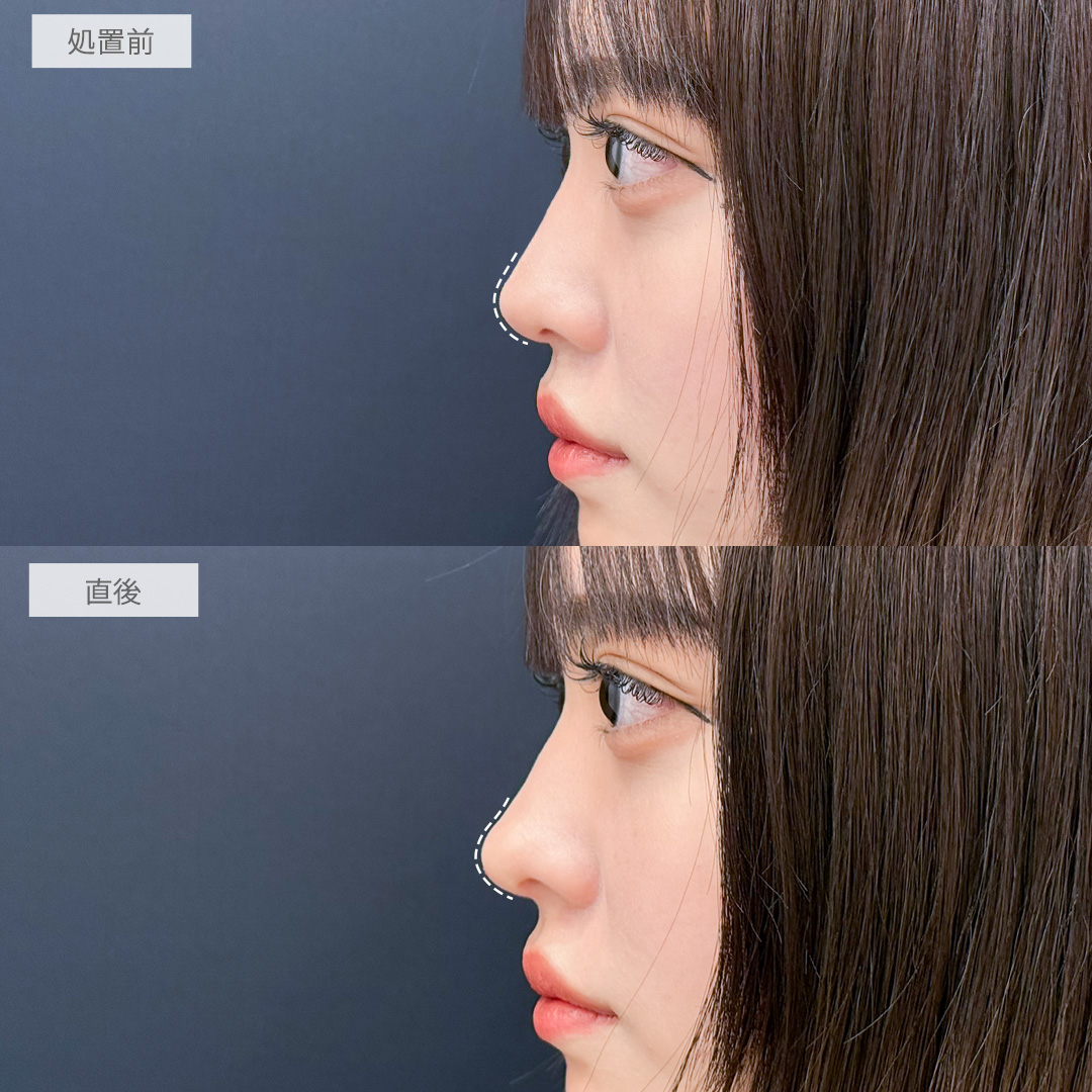 コリアンノーズで鼻先をツンとさせるだけでお顔全体のバランスがより整いました！処置前と直後の症例です(20代女性)