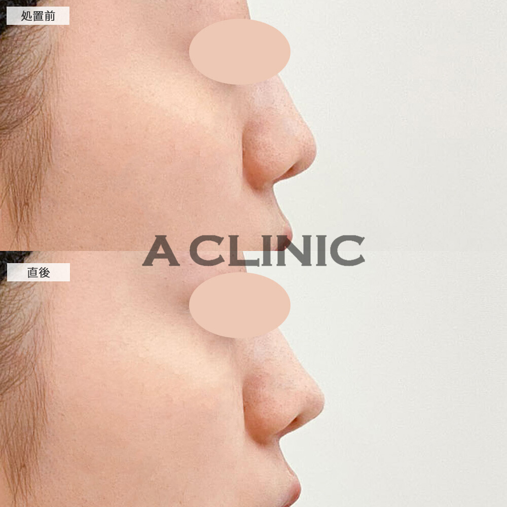 コリアンノーズなら注射のみでツンと上向きの鼻に変化します！こちら処置前と直後の症例です(20代女性)