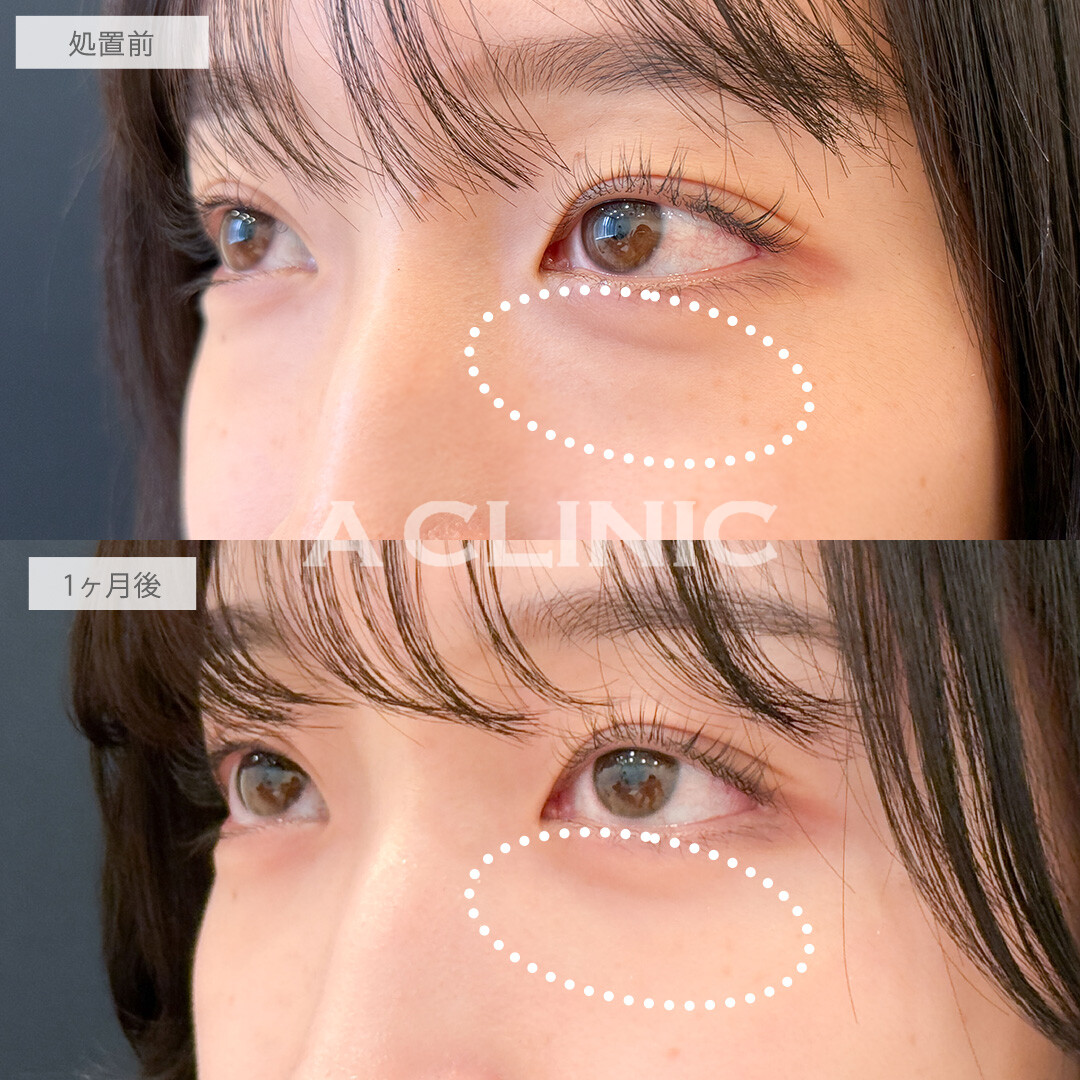 目の下のクマ取りでお疲れ顔から明るい印象に！こちら処置前と1ヶ月後の症例です(20代女性)