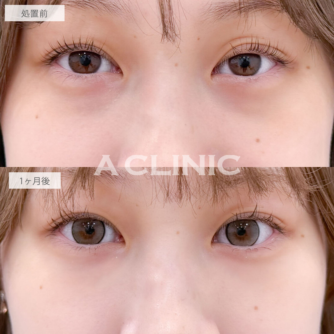 目の下のクマ取りで黒クマ撃退しなめらかで明るい目元に！こちら処置前と1ヶ月後の症例です(20代女性)