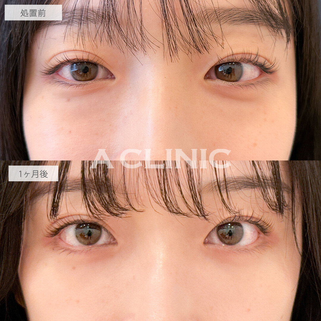 目の下のクマ取りでお疲れ顔から明るい印象に！こちら処置前と1ヶ月後の症例です(20代女性)