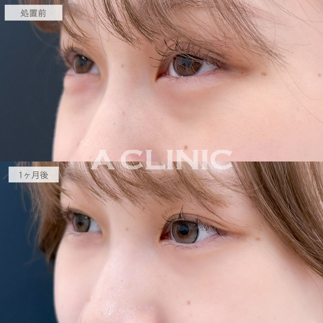 目の下のクマ取りで黒クマ撃退しなめらかで明るい目元に！こちら処置前と1ヶ月後の症例です(20代女性)