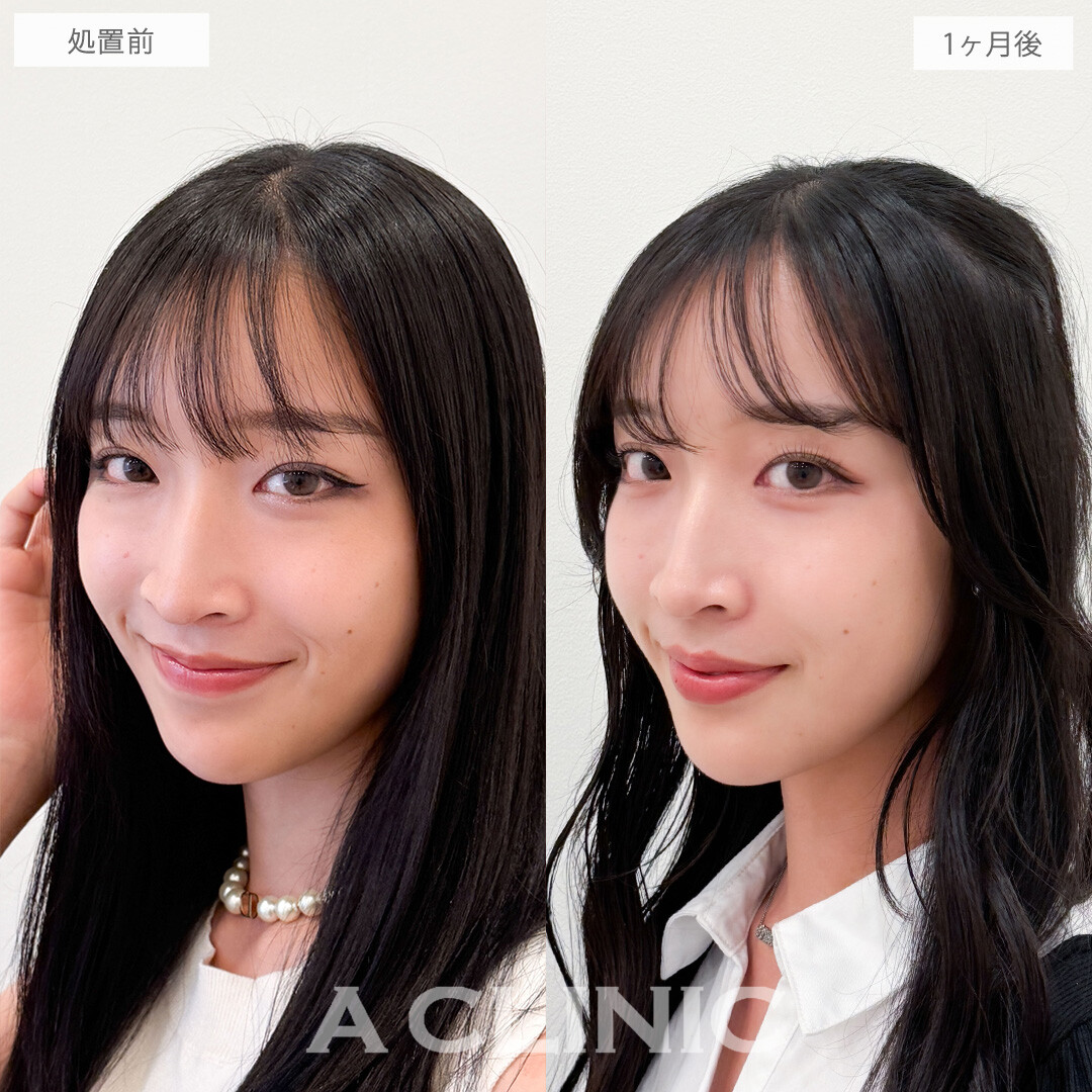 目の下のクマ取りでお疲れ顔から明るい印象に！こちら処置前と1ヶ月後の症例です(20代女性)