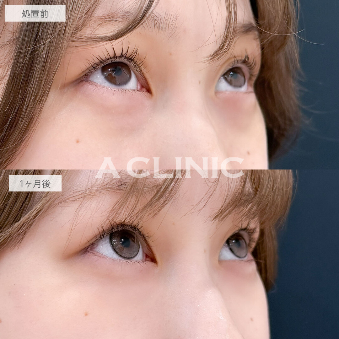 目の下のクマ取りで黒クマ撃退しなめらかで明るい目元に！こちら処置前と1ヶ月後の症例です(20代女性)