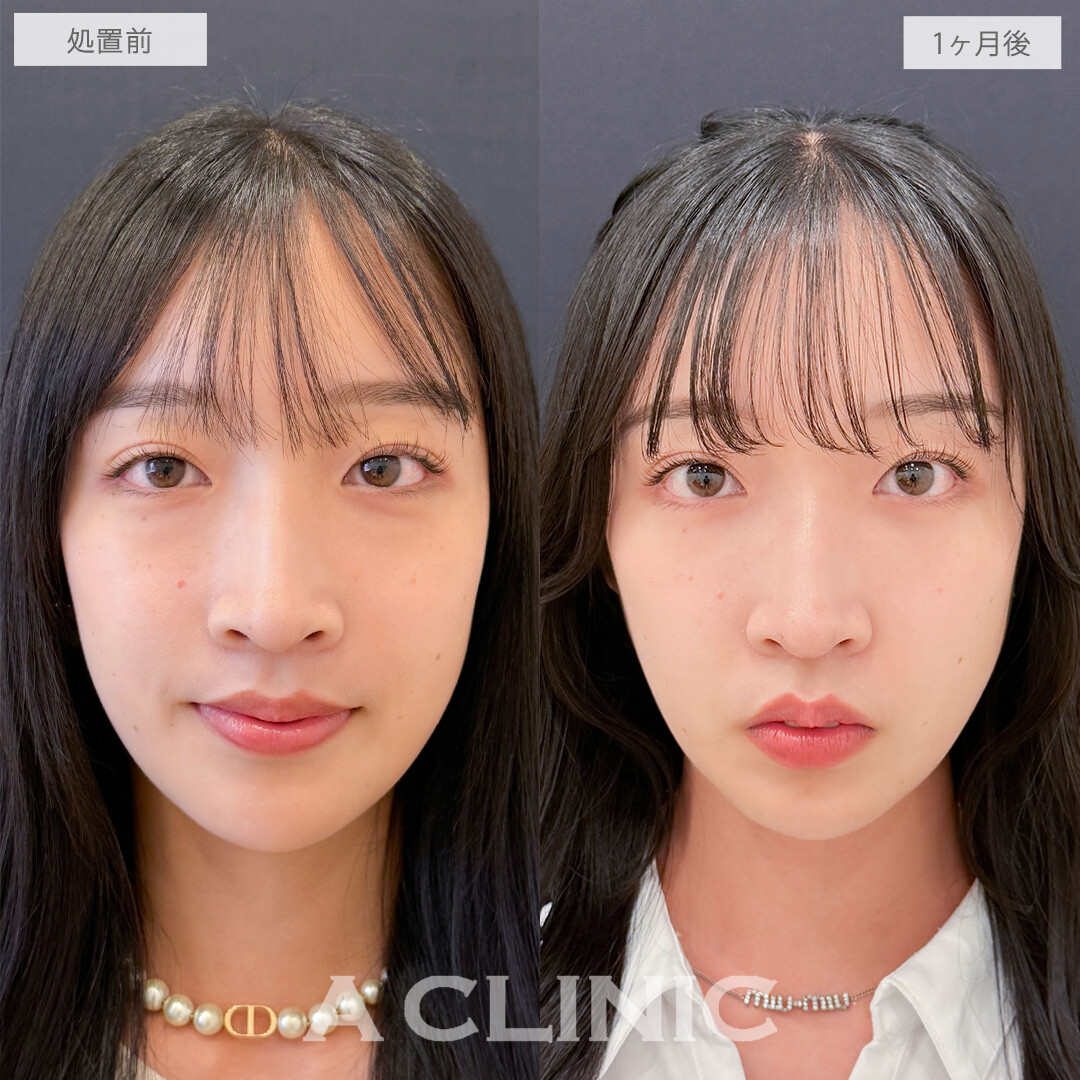目の下のクマ取りでお疲れ顔から明るい印象に！こちら処置前と1ヶ月後の症例です(20代女性)