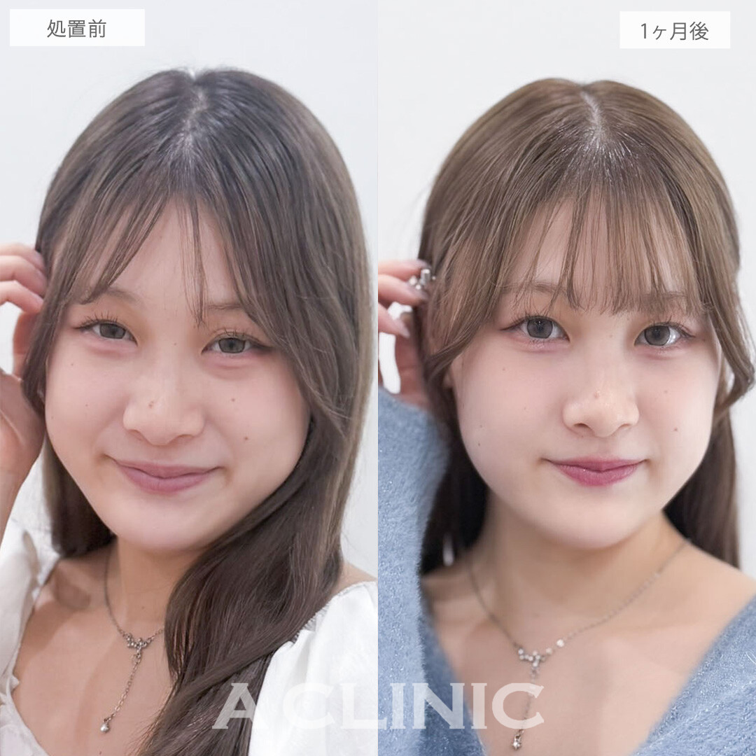 目の下のクマ取りで黒クマ撃退しなめらかで明るい目元に！こちら処置前と1ヶ月後の症例です(20代女性)