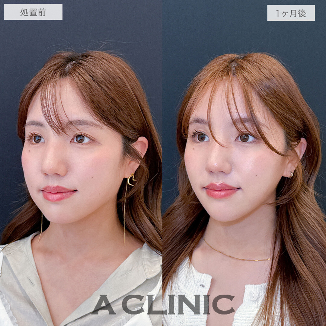 1day小顔脂肪吸引とあごへのヒアルロン酸注入で輪郭が整い美しさがアップデートされました！処置前と1ヶ月後の症例です(20代女性)
