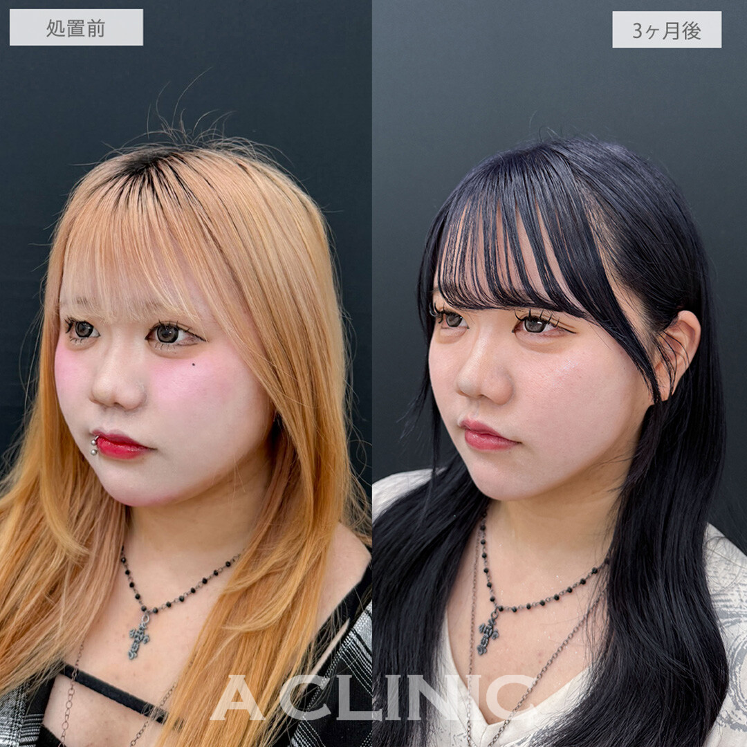 1day小顔脂肪吸引と小顔エラボトックスで別人級の小顔で垢抜け大成功！処置前と3ヶ月後の症例です(10代女性)