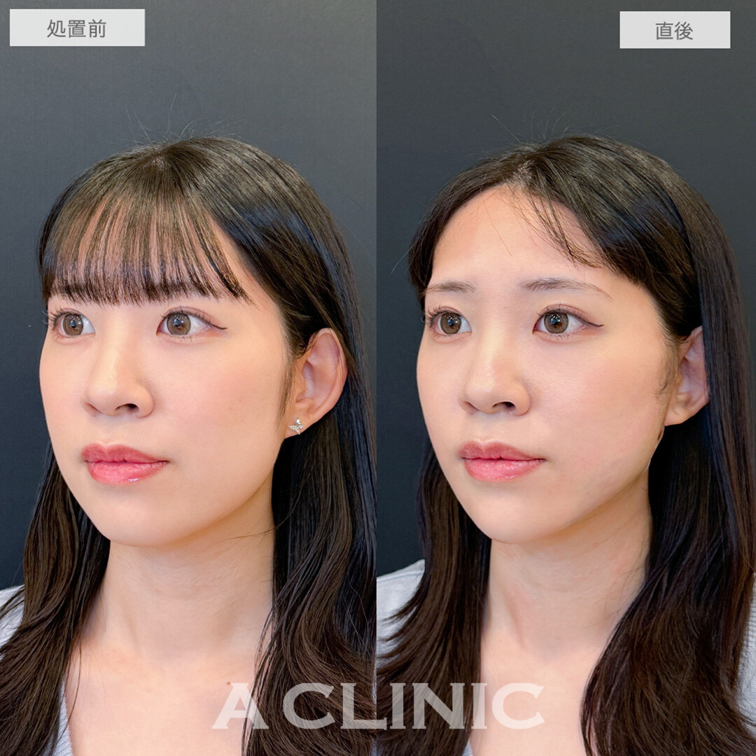 1day小顔脂肪吸引とあごへのヒアルロン酸注入で直後から垢抜け大成功！処置前と直後の症例です(20代女性)