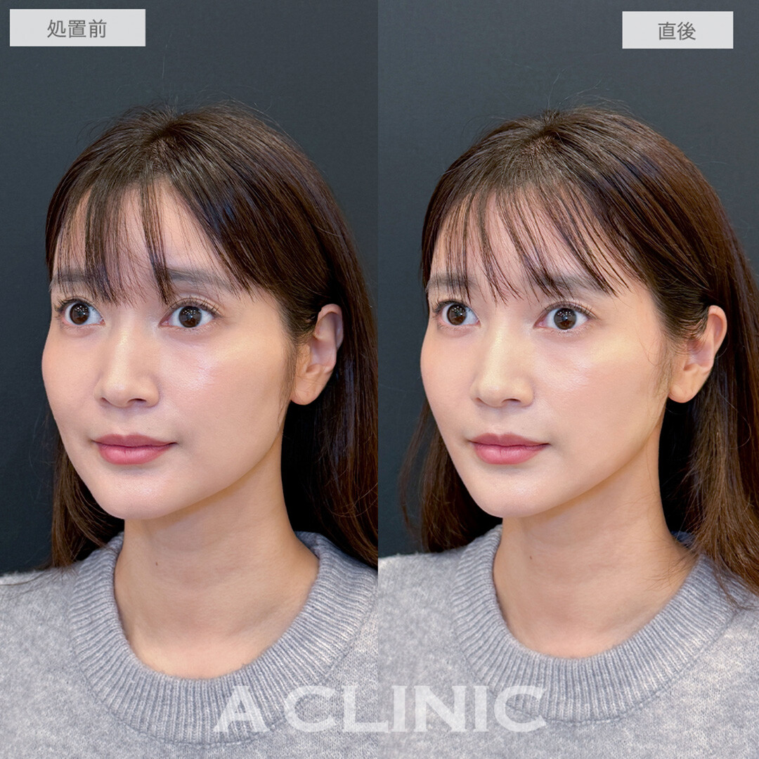Aスレッドでフェイスラインのたるみが引きあがり若々しい印象に大変身！処置前と直後の症例です(30代女性)