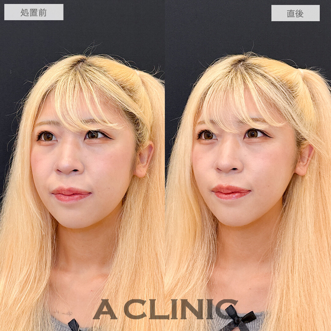 Aスレッドでほうれい線とお顔のたるみが解消され即日若返りが可能に！処置前と直後の症例です(20代女性)