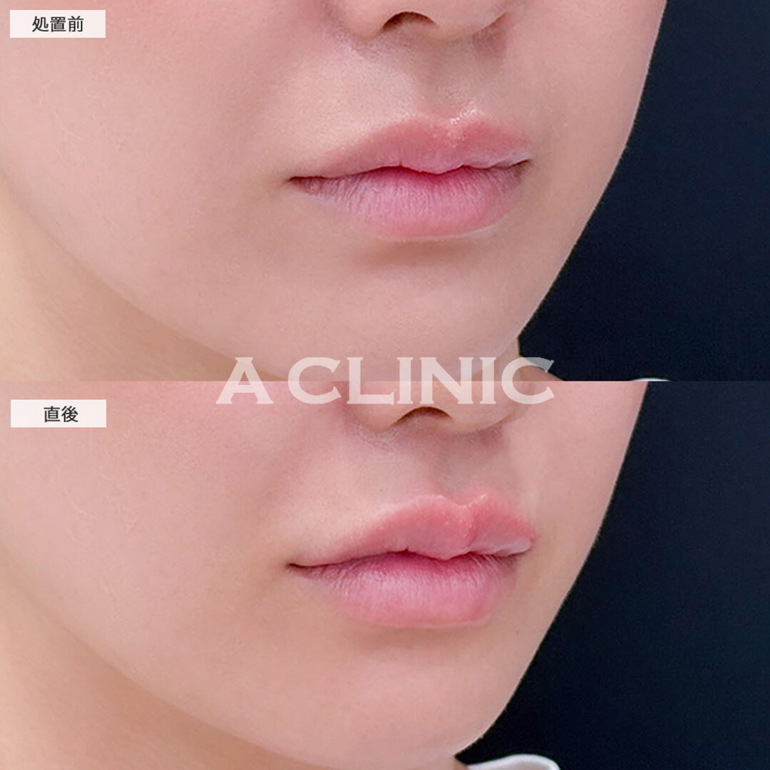 リップヒアルロン酸注入で唇のボリュームアップ！こちら処置前と直後の症例です(20代女性)