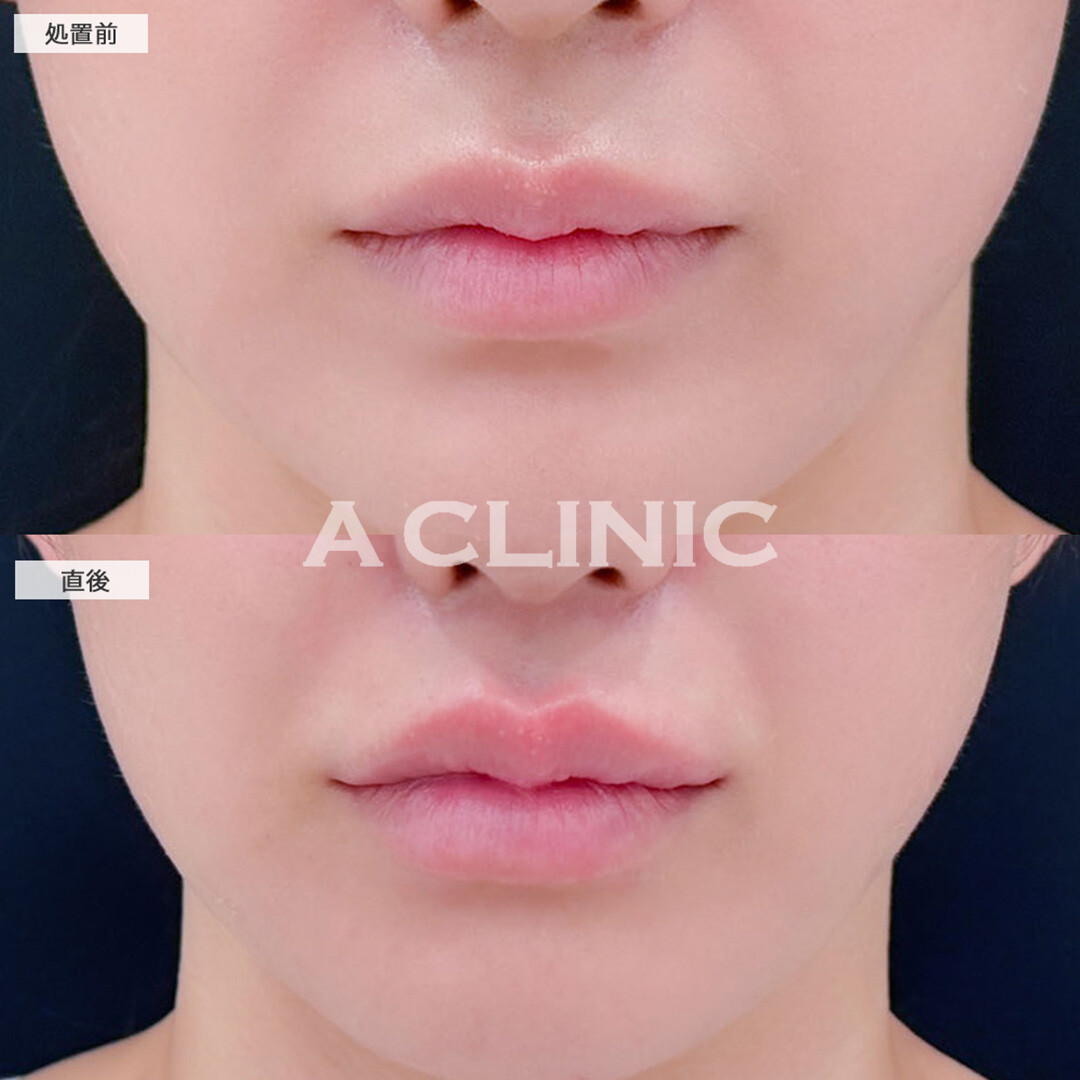 リップヒアルロン酸注入で唇のボリュームアップ！こちら処置前と直後の症例です(20代女性)