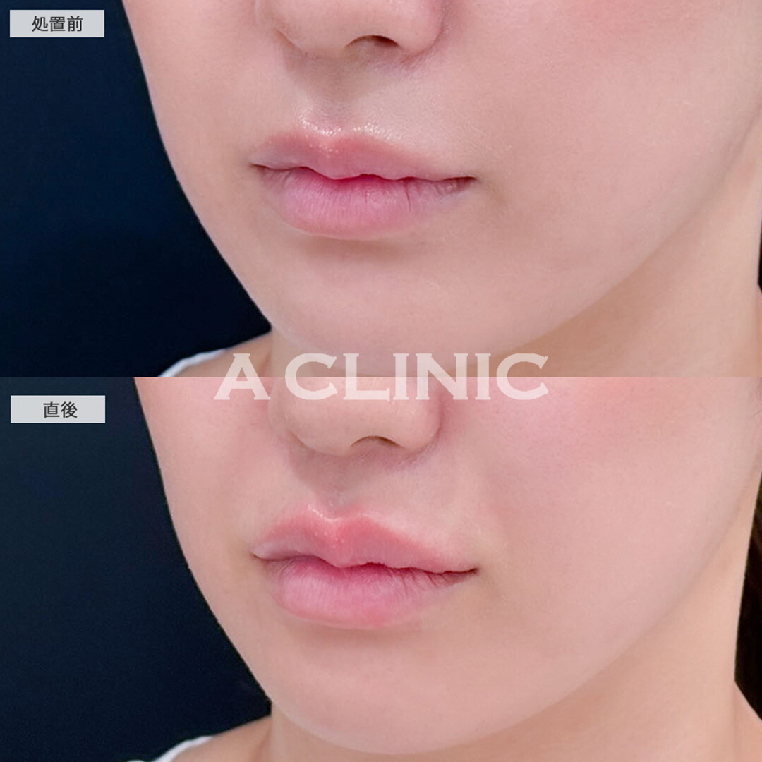 リップヒアルロン酸注入で唇のボリュームアップ！こちら処置前と直後の症例です(20代女性)