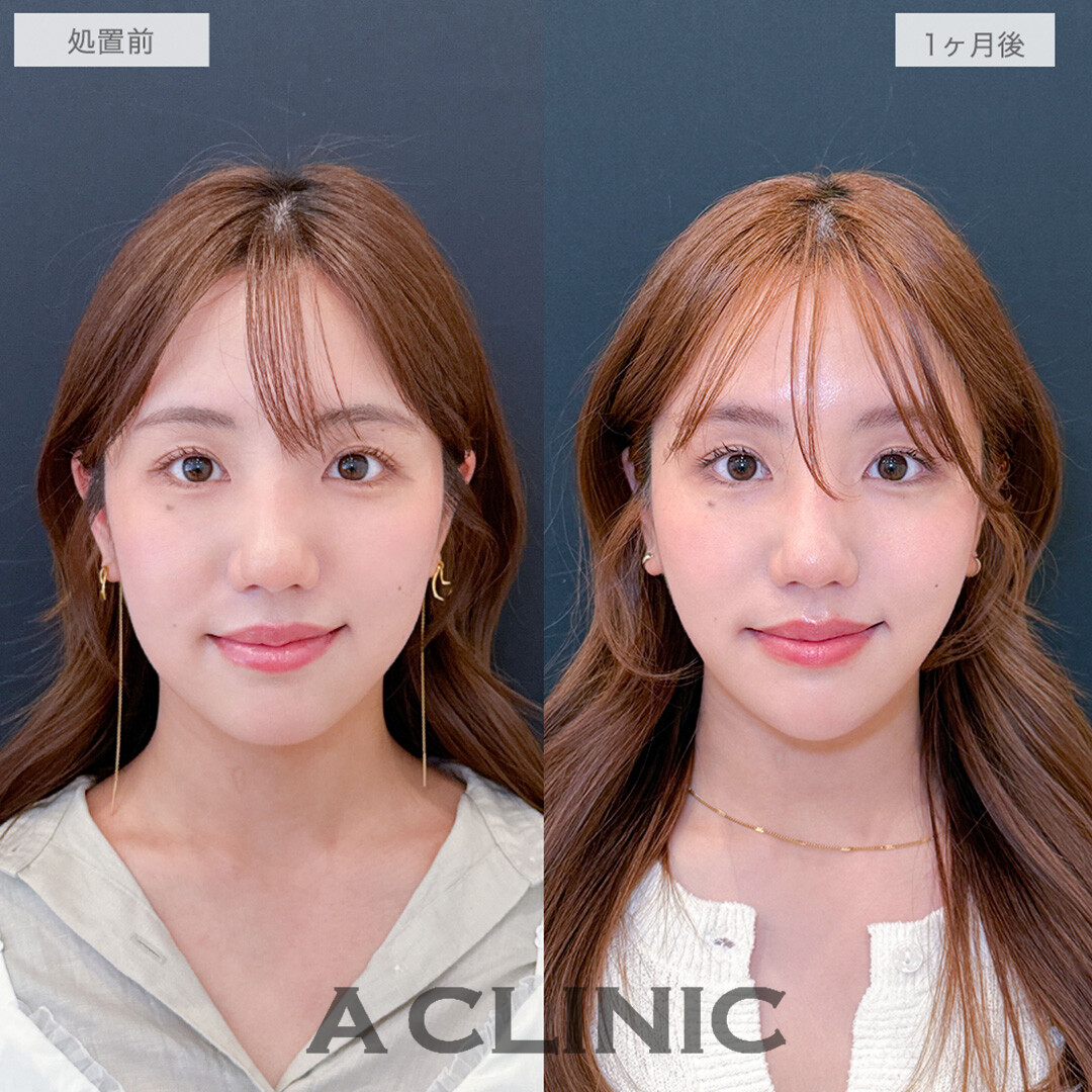 1day小顔脂肪吸引とあごへのヒアルロン酸注入で輪郭が整い美しさがアップデートされました！処置前と1ヶ月後の症例です(20代女性)