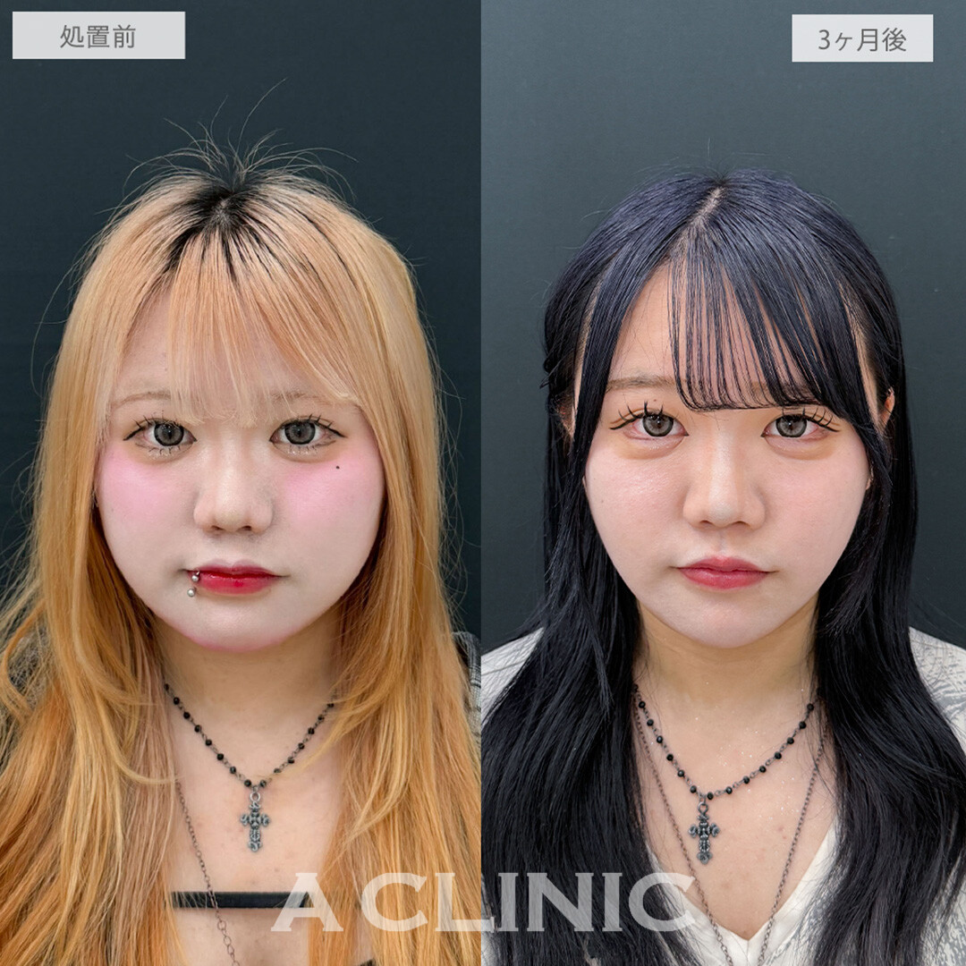 1day小顔脂肪吸引と小顔エラボトックスで別人級の小顔で垢抜け大成功！処置前と3ヶ月後の症例です(10代女性)