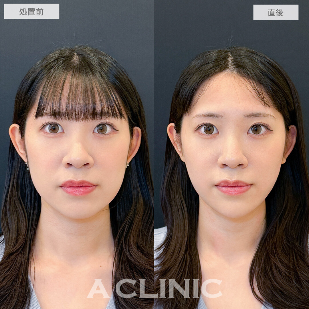 1day小顔脂肪吸引とあごへのヒアルロン酸注入で直後から垢抜け大成功！処置前と直後の症例です(20代女性)
