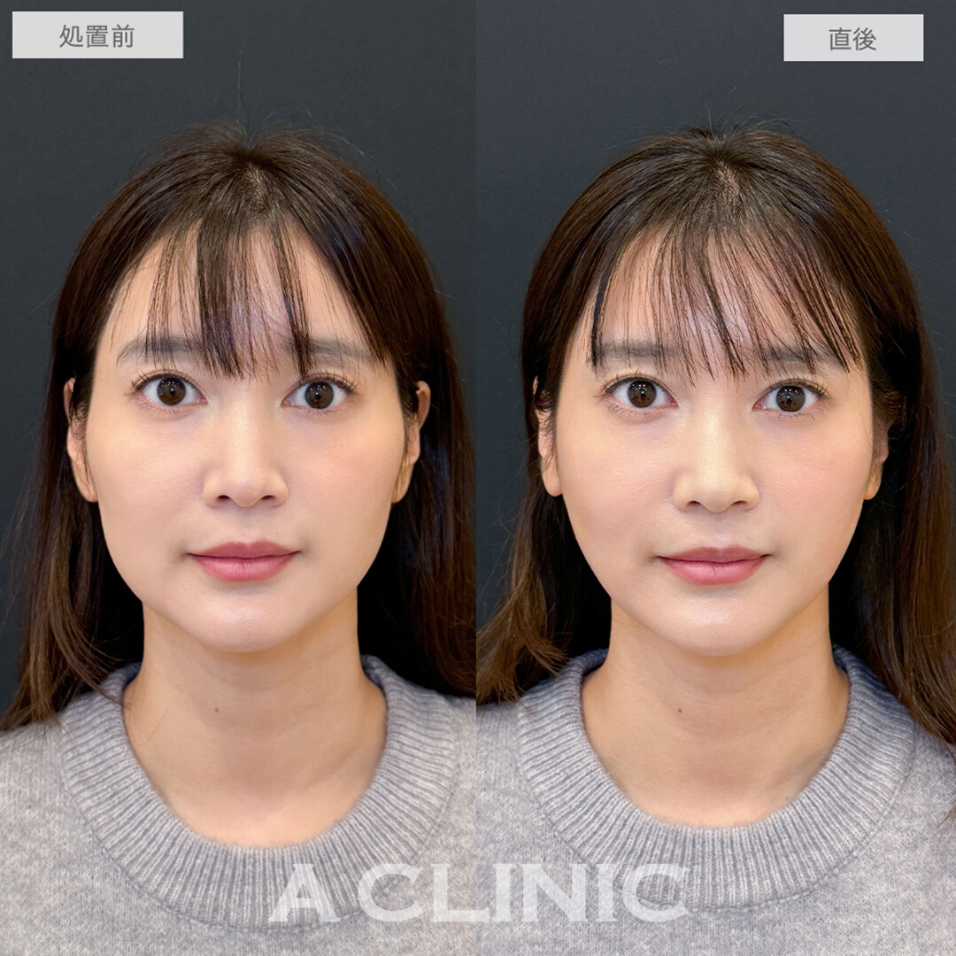 Aスレッドでフェイスラインのたるみが引きあがり若々しい印象に大変身！処置前と直後の症例です(30代女性)