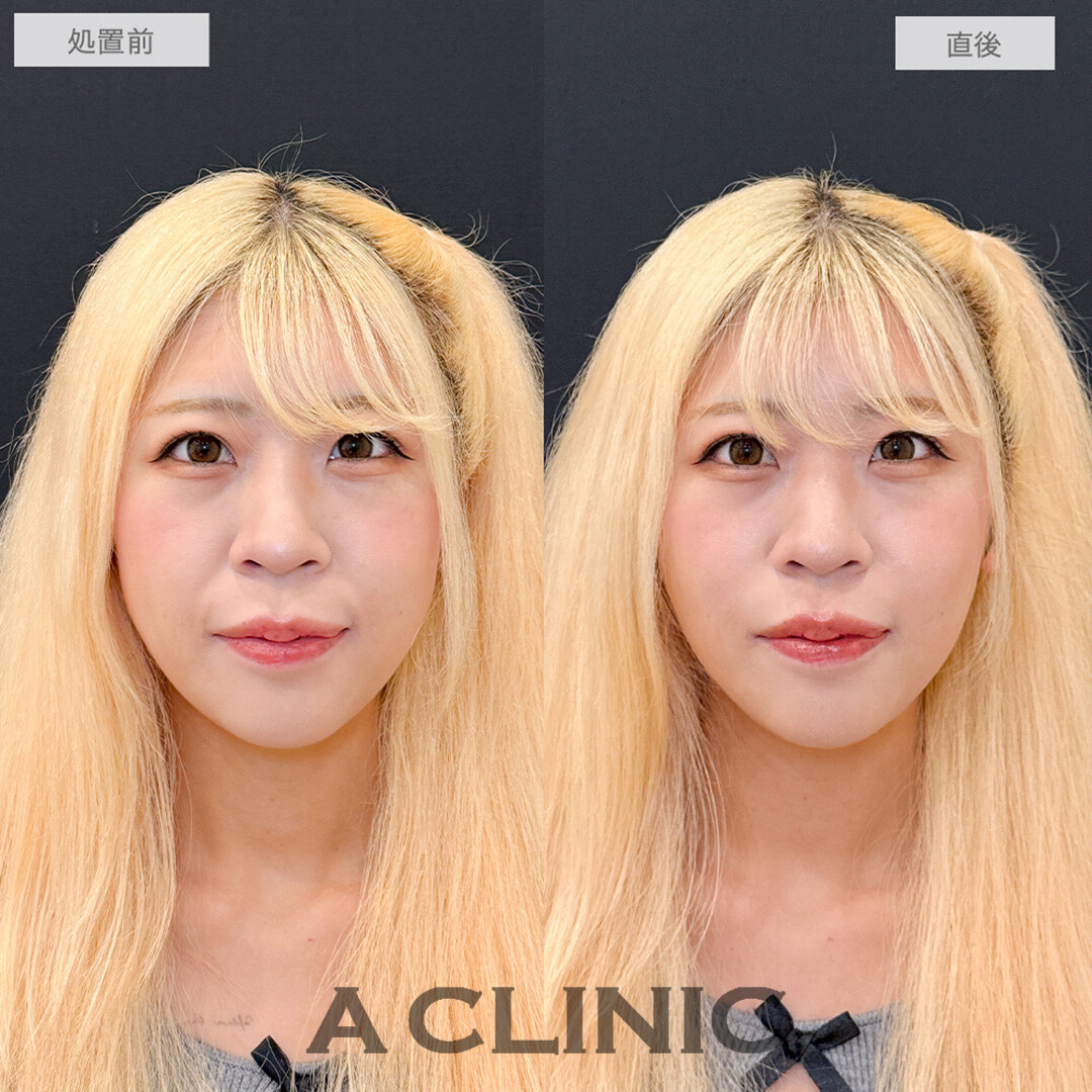 Aスレッドでほうれい線とお顔のたるみが解消され即日若返りが可能に！処置前と直後の症例です(20代女性)