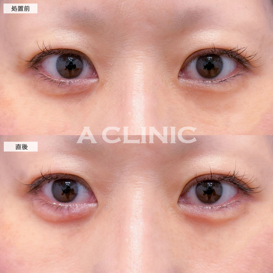 涙袋形成術(ヒアルロン酸)でメイクしていなくてもぷっくりとした涙袋が叶います！こちら処置前と直後の症例です(40代女性)