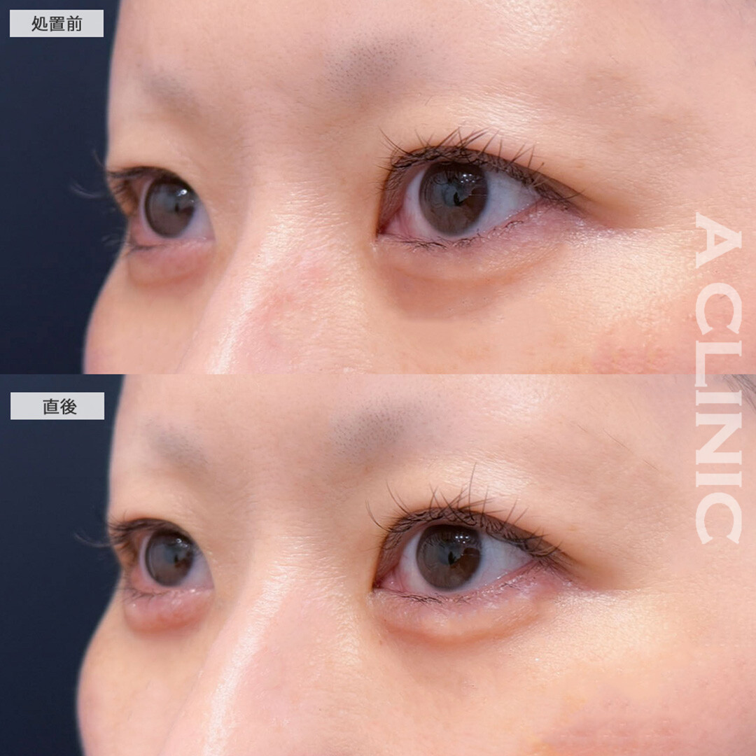 涙袋形成術(ヒアルロン酸)でメイクしていなくてもぷっくりとした涙袋が叶います！こちら処置前と直後の症例です(40代女性)