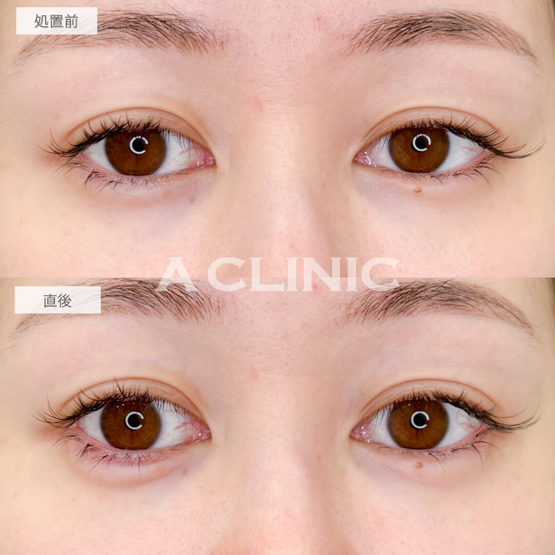 涙袋形成術(ヒアルロン酸)でパッチリな目になれました！処置前と直後の症例です(30代女性)