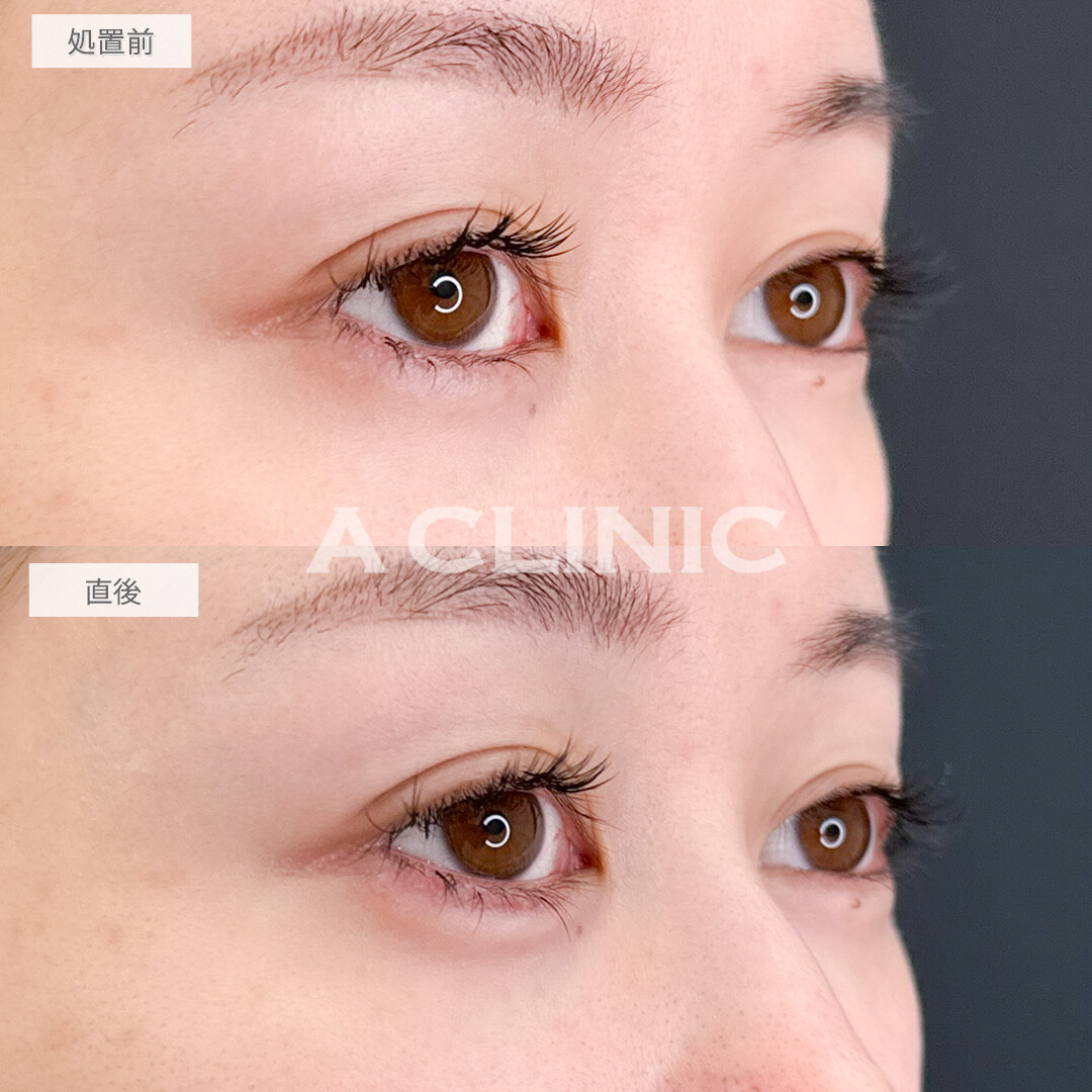 涙袋形成術(ヒアルロン酸)でパッチリな目になれました！処置前と直後の症例です(30代女性)