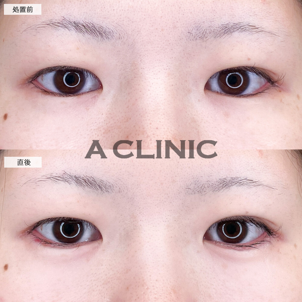 涙袋形成術(ヒアルロン酸)で涙袋をメイクで作らず外出できるようになりました！こちら処置前と直後の症例です(20代女性)