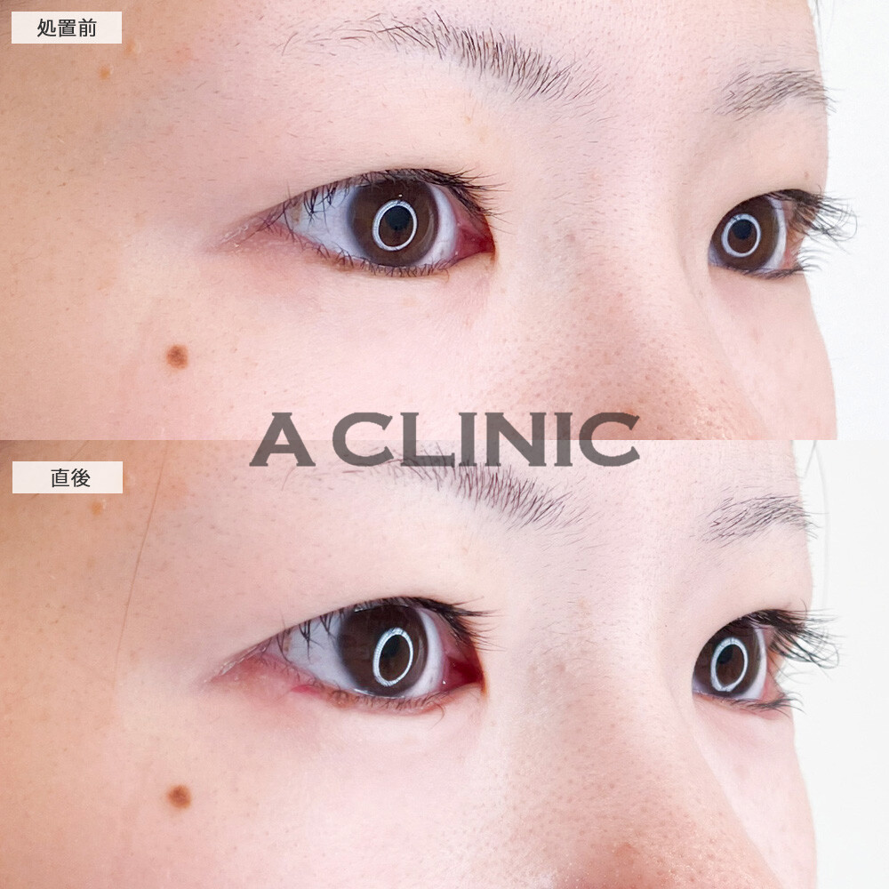 涙袋形成術(ヒアルロン酸)で涙袋をメイクで作らず外出できるようになりました！こちら処置前と直後の症例です(20代女性)