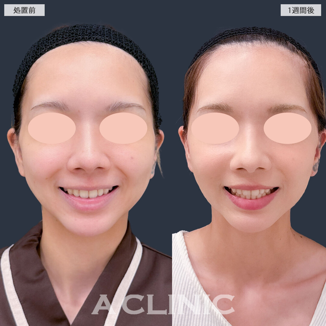 Ａ式ナゾラリフトはほうれい線まわりのお悩みにアプローチ！こちら処置前と1週間後の症例です(20代女性)