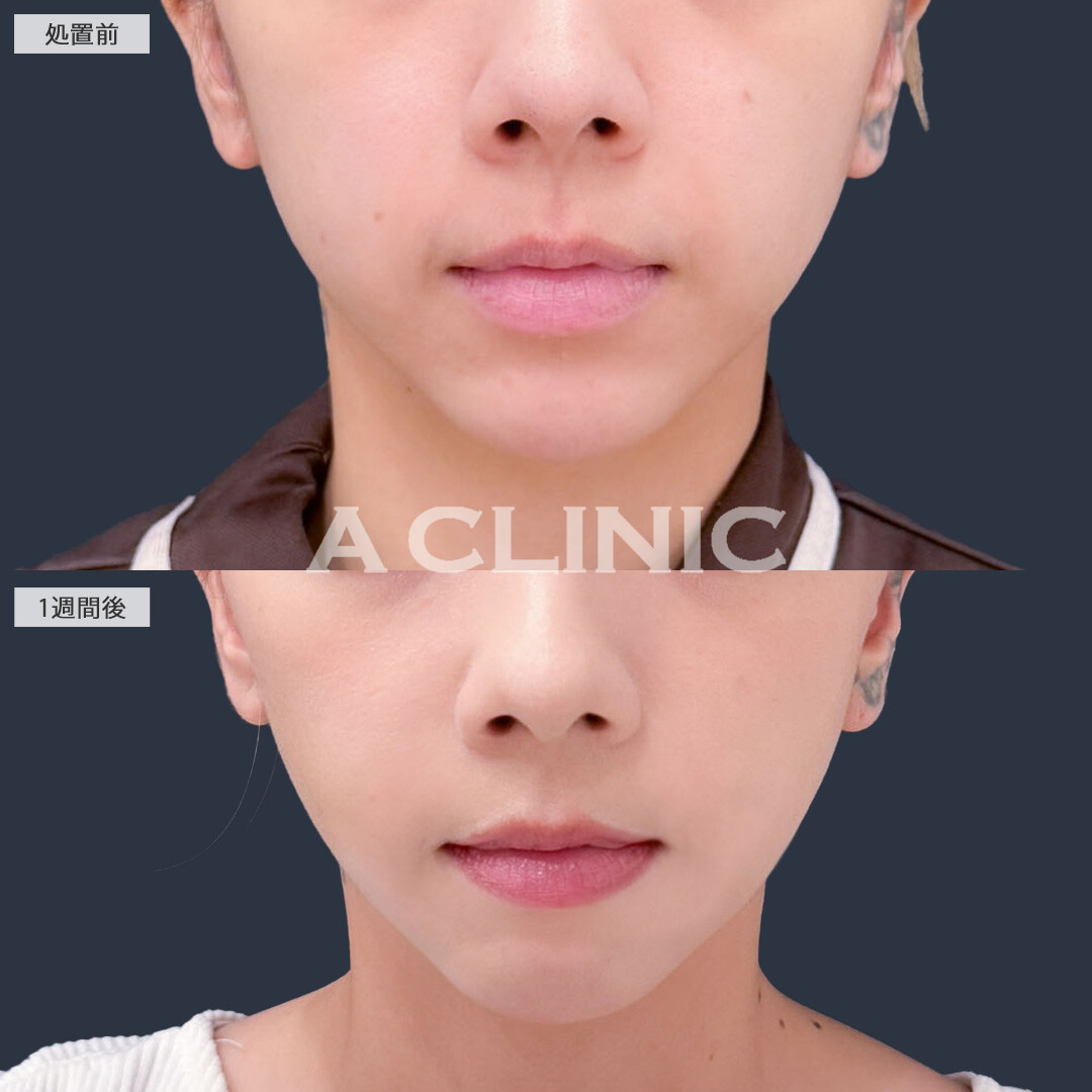 Ａ式ナゾラリフトはほうれい線まわりのお悩みにアプローチ！こちら処置前と1週間後の症例です(20代女性)