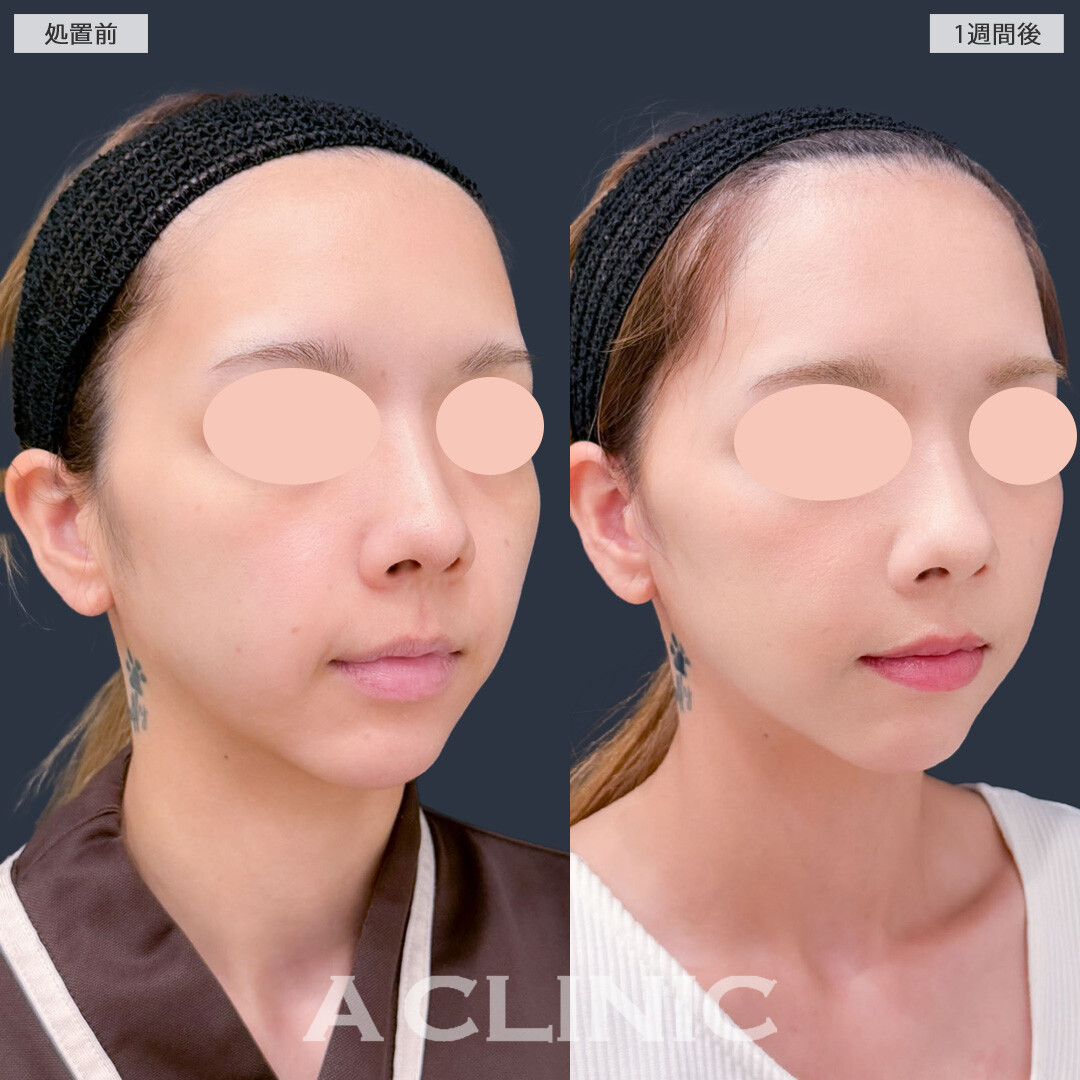 Ａ式ナゾラリフトはほうれい線まわりのお悩みにアプローチ！こちら処置前と1週間後の症例です(20代女性)