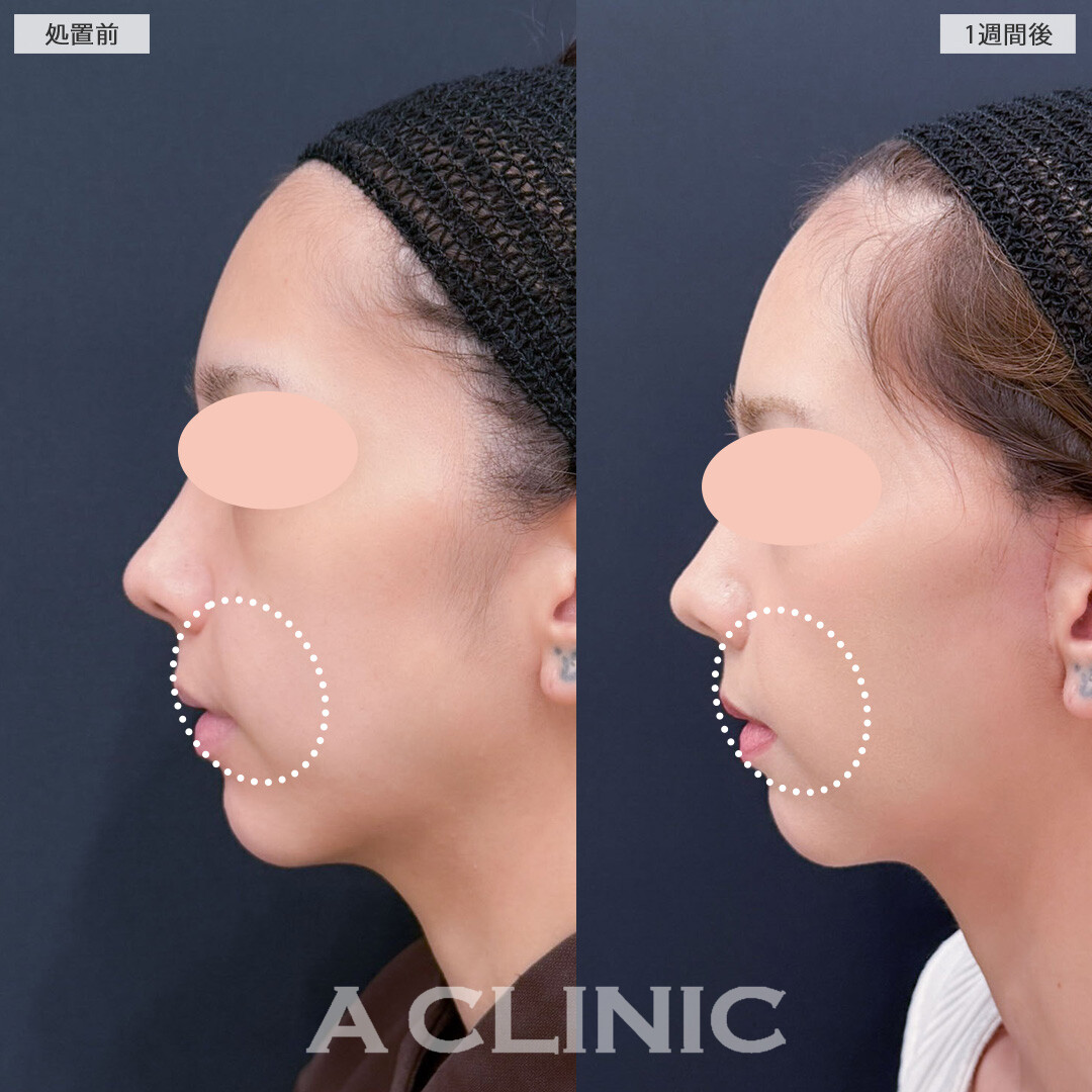Ａ式ナゾラリフトはほうれい線まわりのお悩みにアプローチ！こちら処置前と1週間後の症例です(20代女性)