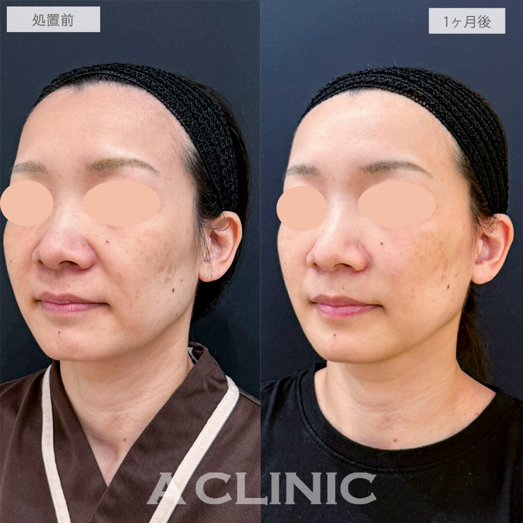 A式ナゾラリフトでマイナス10歳若返りました！こちら処置前と1ヶ月後の症例です(40代女性)