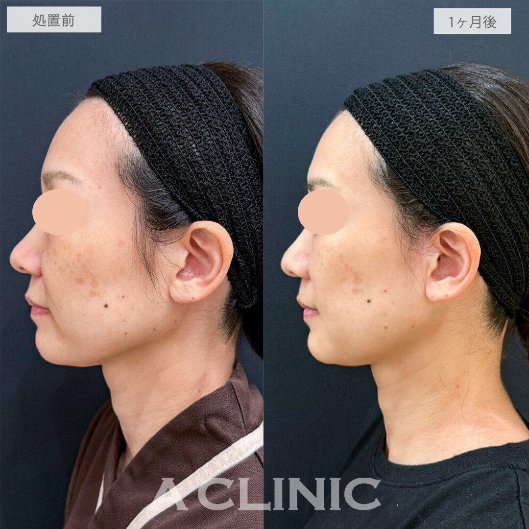 A式ナゾラリフトでマイナス10歳若返りました！こちら処置前と1ヶ月後の症例です(40代女性)