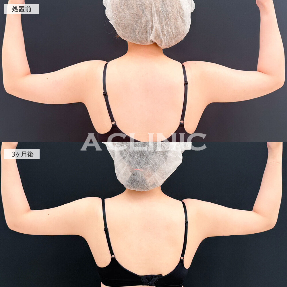 二の腕スリム脂肪吸引で痩せづらい二の腕もダイエットなしですっきり！こちら処置前と3ヶ月後の症例です(20代女性)