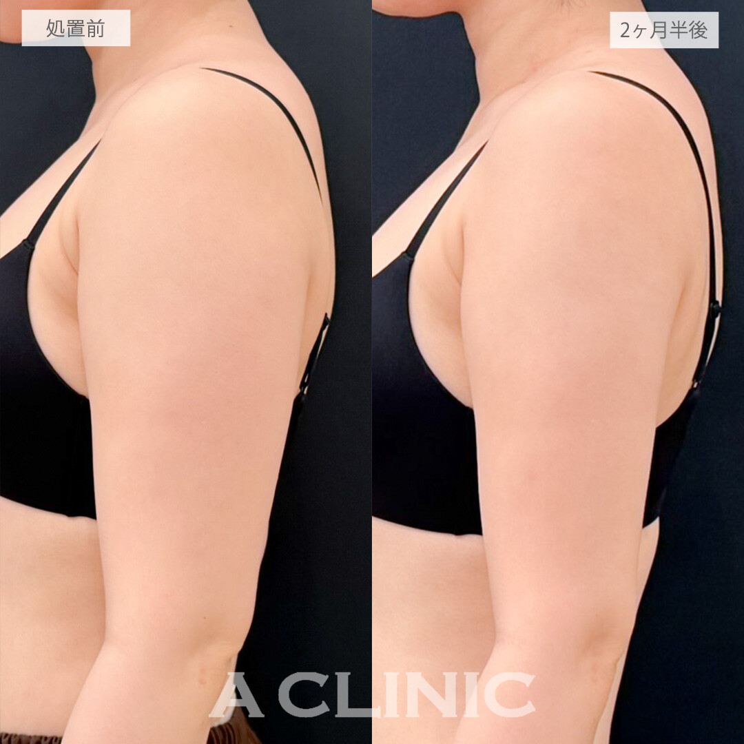 二の腕スリム脂肪吸引で脂肪の付きやすい上半身をスッキリさせてスタイルのバランスが良くなりました！処置前と2ヶ月半後の症例です(20代女性)