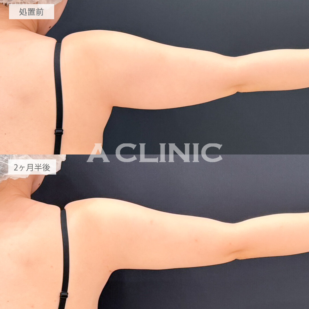 二の腕スリム脂肪吸引で脂肪の付きやすい上半身をスッキリさせてスタイルのバランスが良くなりました！処置前と2ヶ月半後の症例です(20代女性)