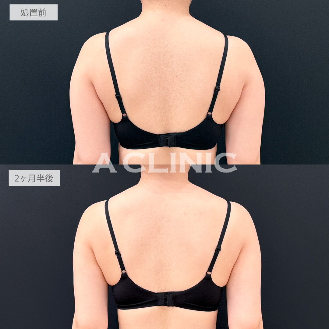 二の腕スリム脂肪吸引で脂肪の付きやすい上半身をスッキリさせてスタイルのバランスが良くなりました！処置前と2ヶ月半後の症例です(20代女性)
