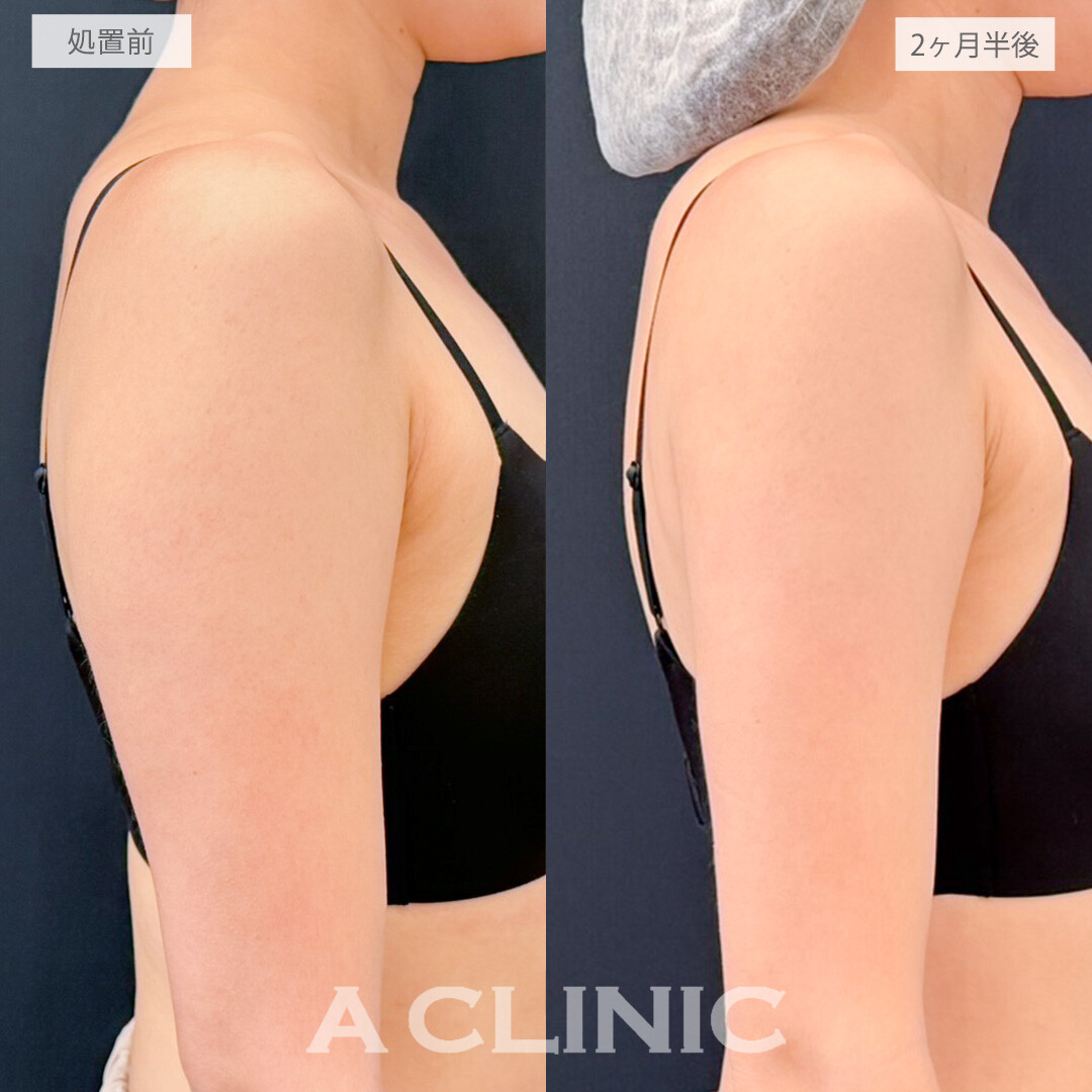 二の腕スリム脂肪吸引で憧れの華奢なスタイルになれました！処置前と2ヶ月半後の症例です(20代女性)