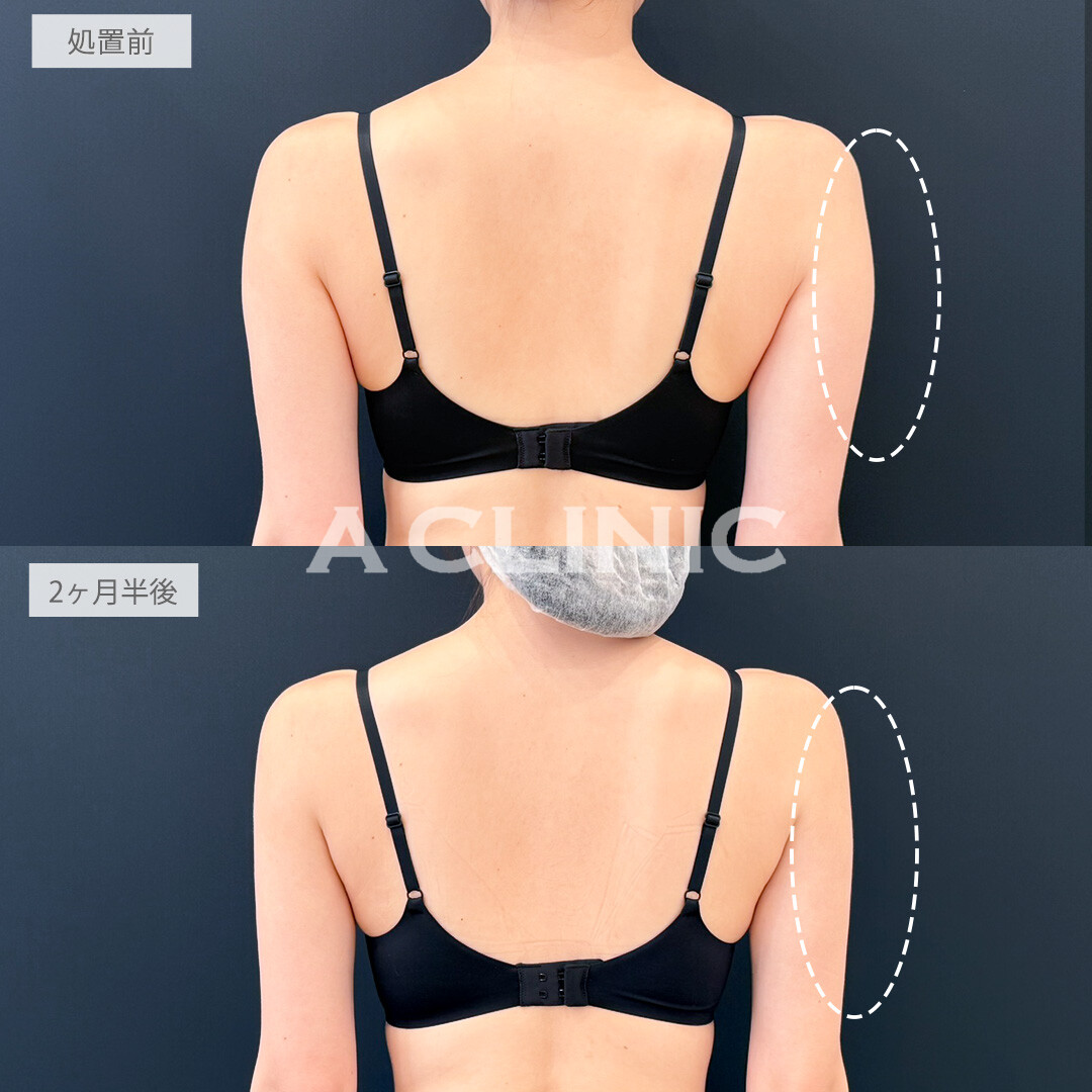 二の腕スリム脂肪吸引で憧れの華奢なスタイルになれました！処置前と2ヶ月半後の症例です(20代女性)