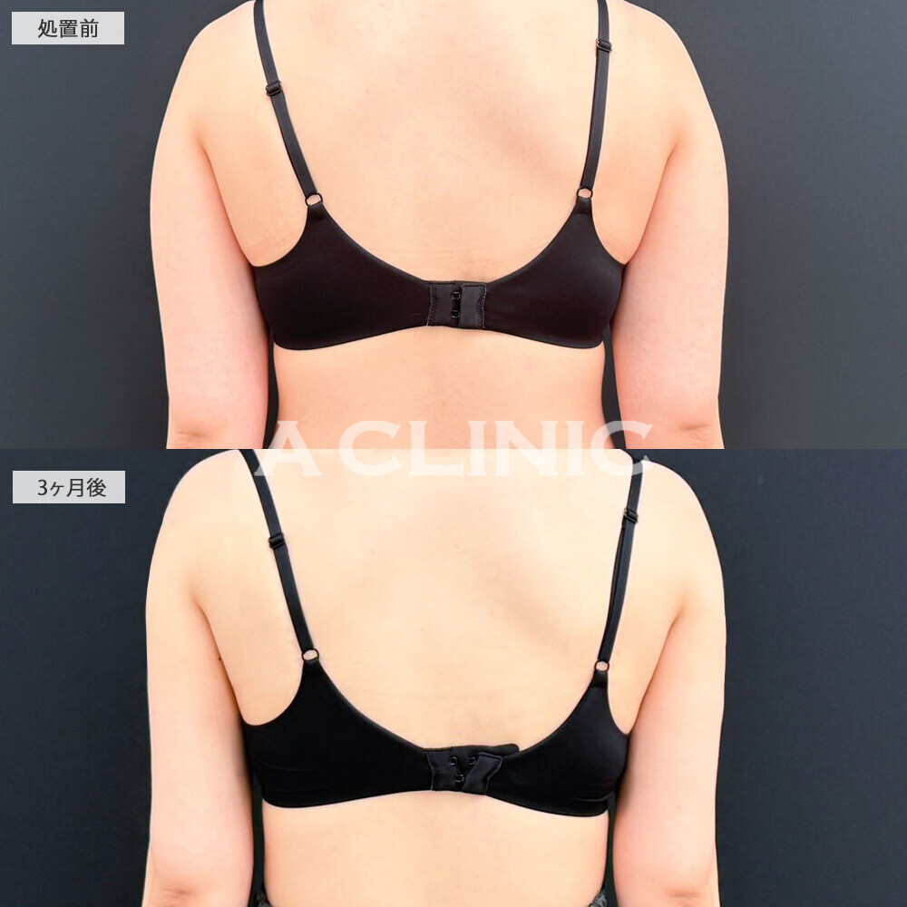 二の腕スリム脂肪吸引で痩せづらい二の腕もダイエットなしですっきり！こちら処置前と3ヶ月後の症例です(20代女性)