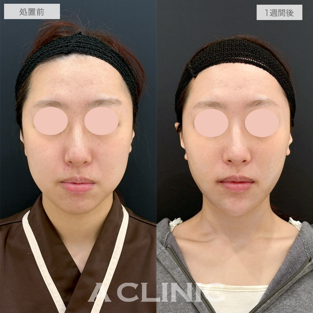 複合施術で笑顔も整い垢抜け感のある小顔になりました！処置前と1週間後の症例です(20代女性)