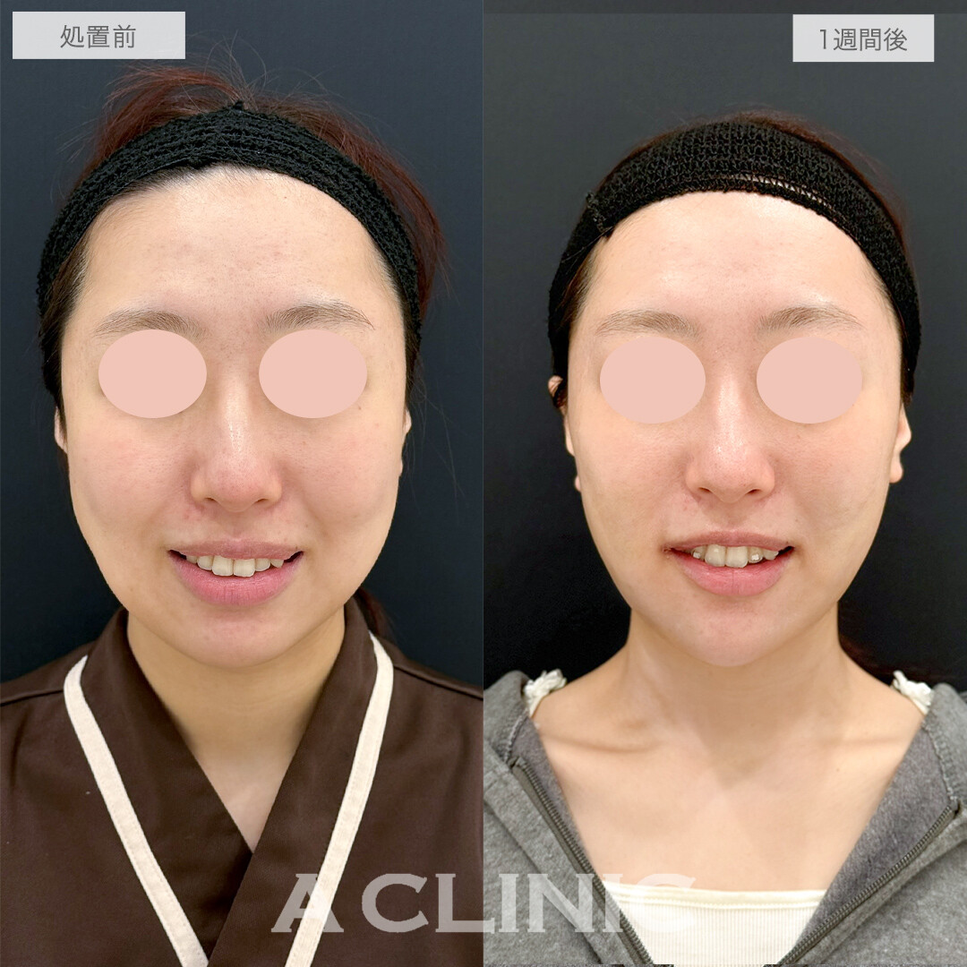 複合施術で笑顔も整い垢抜け感のある小顔になりました！処置前と1週間後の症例です(20代女性)