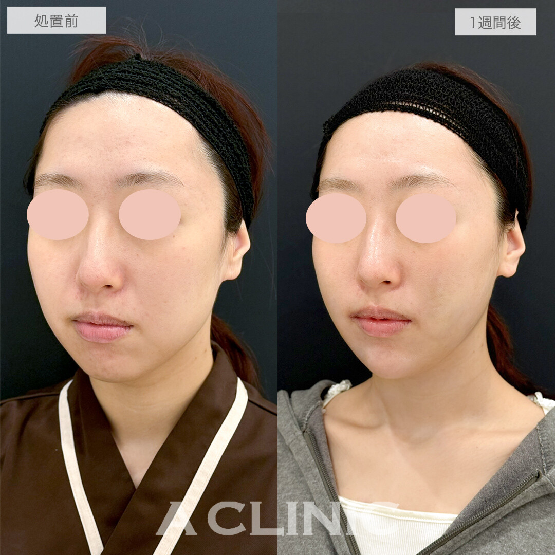 複合施術で笑顔も整い垢抜け感のある小顔になりました！処置前と1週間後の症例です(20代女性)