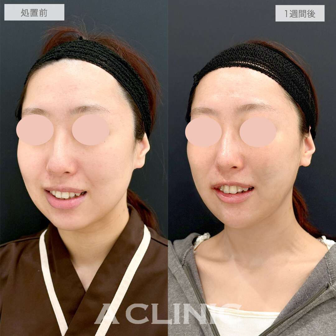 複合施術で笑顔も整い垢抜け感のある小顔になりました！処置前と1週間後の症例です(20代女性)